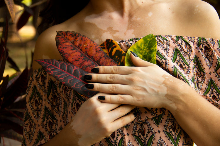 Vitiligo in Brazil